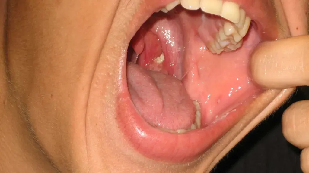 can tonsils grow back